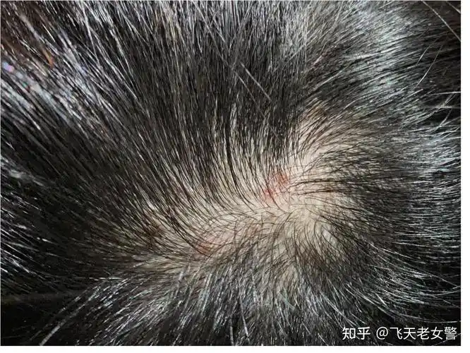 男生自己头皮屑太多,洗不干净,有啥好用的男士洗发水吗?