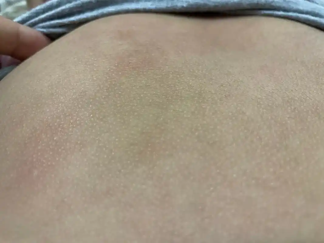 孩子后背痒.孩子后背感觉鸡皮一样,增厚的感觉,她胸前也有,很 - 抖音