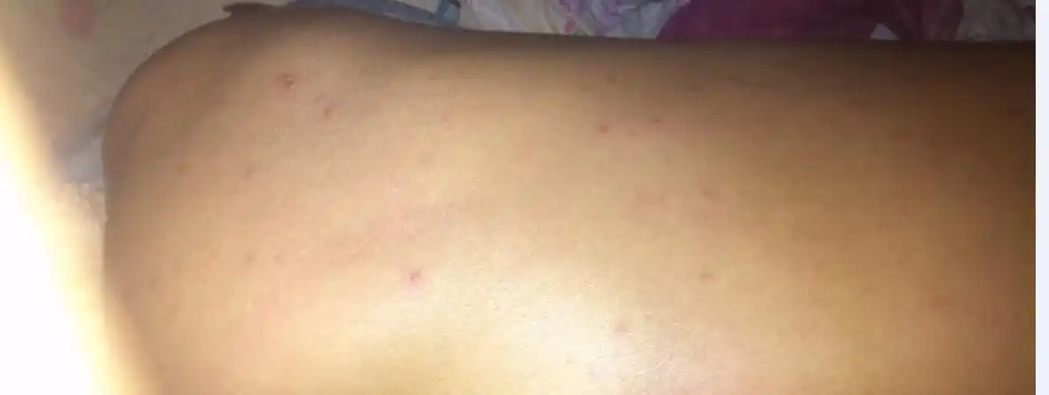 抹了很久的硫磺药膏了背上的是疥疮吗?