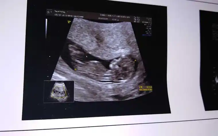 13周nt图脊柱弯着就是男孩这种说法准吗