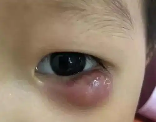 眼睛长了麦粒肿怎么办 - 搜狗图片搜索