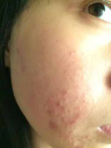 这是毛囊发炎吗?