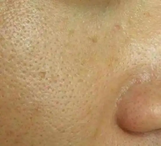 我们脸上有好几万的毛孔,这些毛孔都会分泌油脂来保护我们的皮肤,但