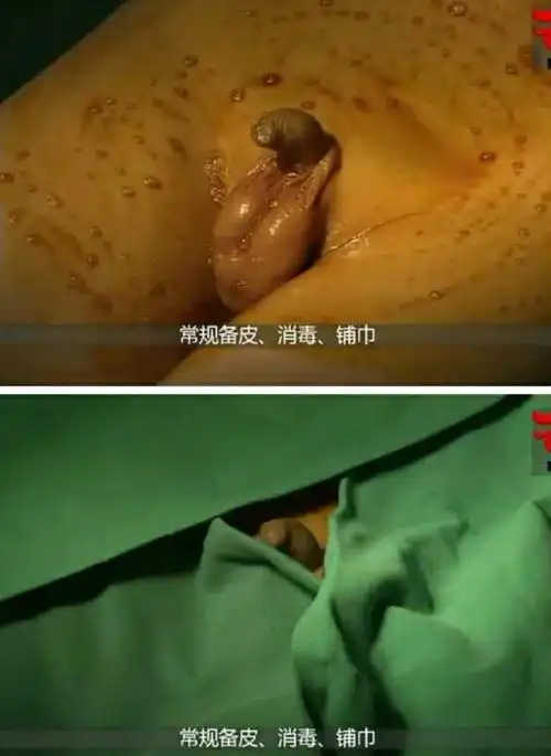 小孩包皮包茎知识普及美篇