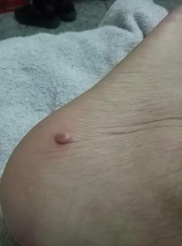 脚上长了个肉疙瘩,不痛不痒,用不用切