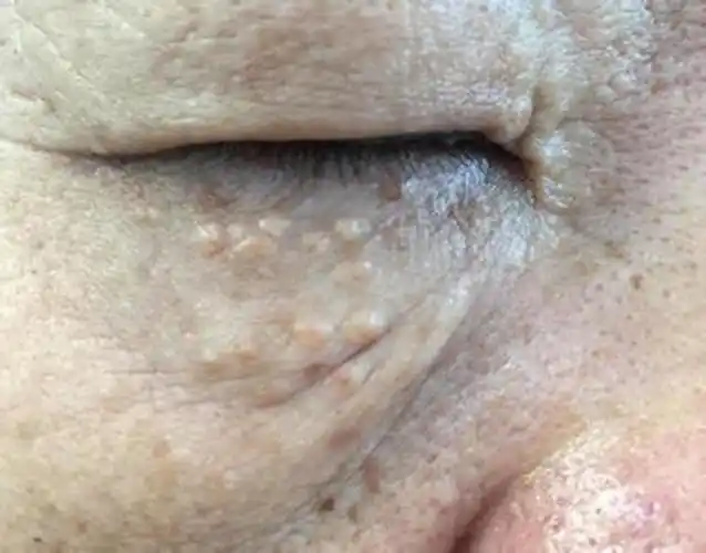 眼皮下方长扁平疣图片