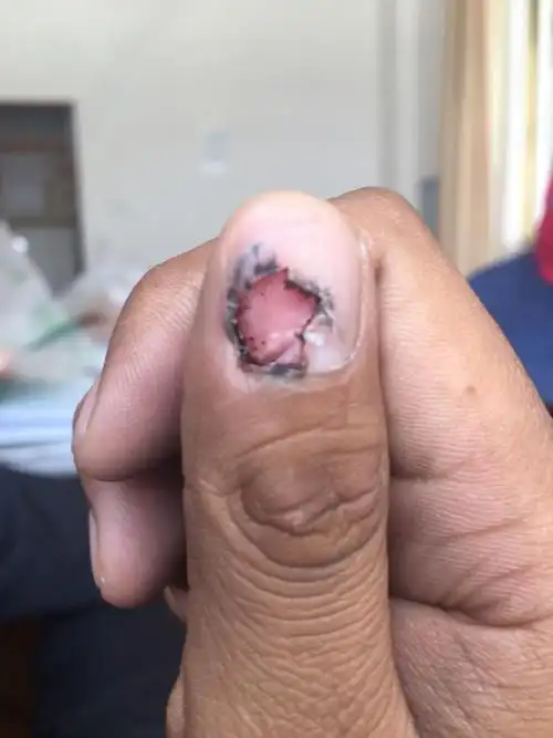 这个拇指指甲一边掉了一边没掉,掉的这边也很难长出来.