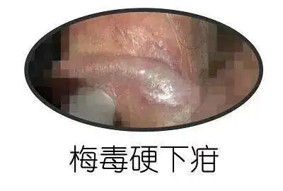 界限清楚,边缘略隆起,溃疡面清洁,呈软骨样硬度,叫"硬下疳",主要发生
