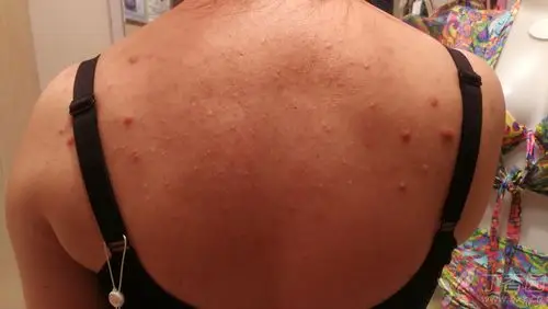 后背粉刺多年怎么治疗?