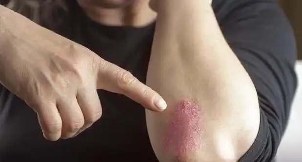 手部牛皮癣症状图片_银屑病求医网