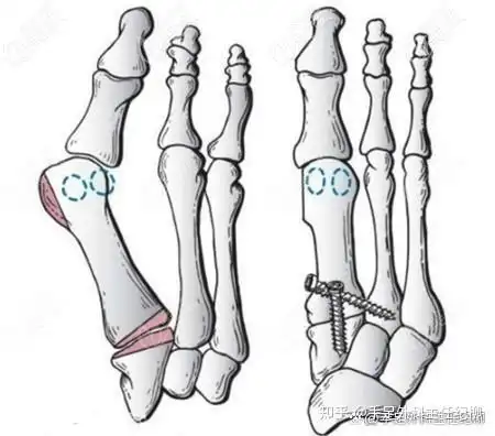 治疗拇外翻常用的传统手术包括软组织手术和截骨手术,这类手术需要在