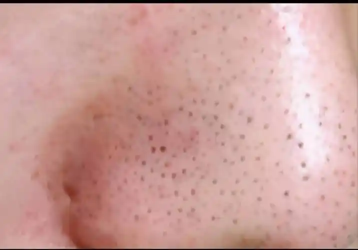 鼻子上有黑头怎么办(鼻子上总长黑头如何科学有效去除?)「技巧分享」-