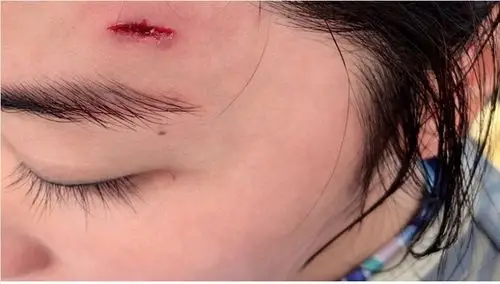 阿sa冲浪额头不慎受伤,伤口流血严重引粉丝心疼