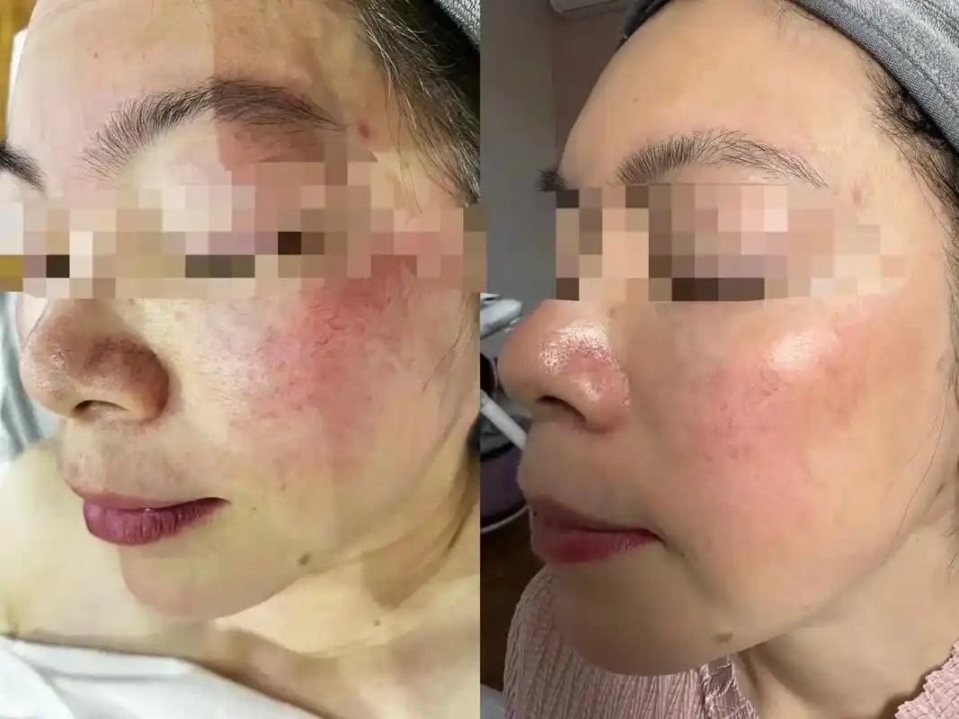 今日修复案例肤屏红血丝修复20天的效果三蛋白 多肽 高补 - 抖音