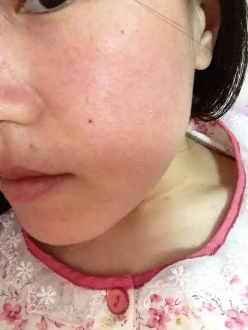 如何增厚角质层?