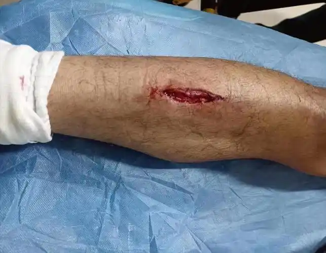 武汉长江13武汉三镇许东遭铲被抬进救护车小腿伤口触目惊心