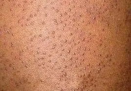 粗糙或鸡皮样外观,可见分散的,针头大,尖顶,毛囊性丘疹,中心有角质栓