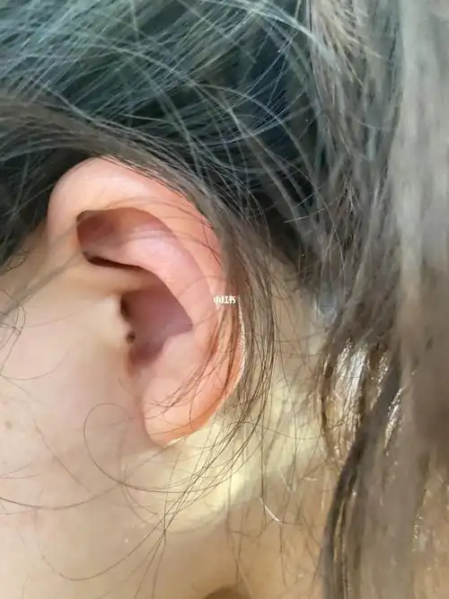 耳朵上这个痣能点掉不