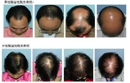 为什么80%的人会得脂溢性脱发?