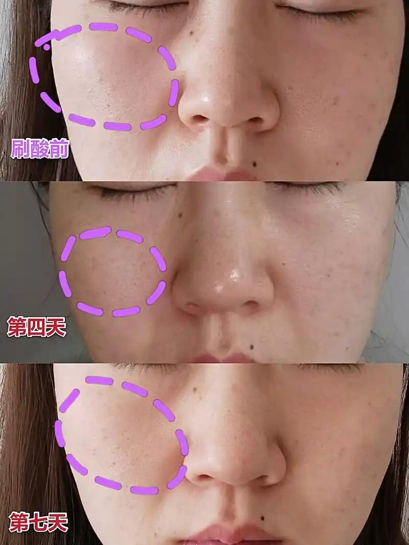 我是上周做的果酸焕肤,现在给大家聊聊恢复的过程和效果