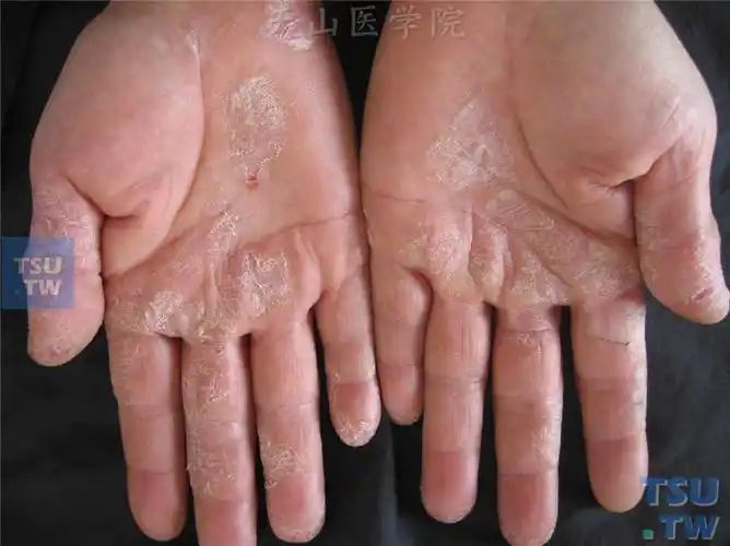 【图】围绝经期角皮症的症状表现 - 皮肤病诊断图谱 - 天山医学院