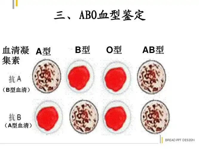 三,abo血型鉴定 血清凝 aa型 集素 b型 o型 ab型 bc d (b型血清) (a型