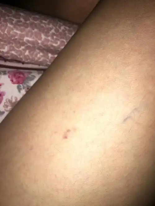 大腿出现大红点和很粗的血丝是什么呀