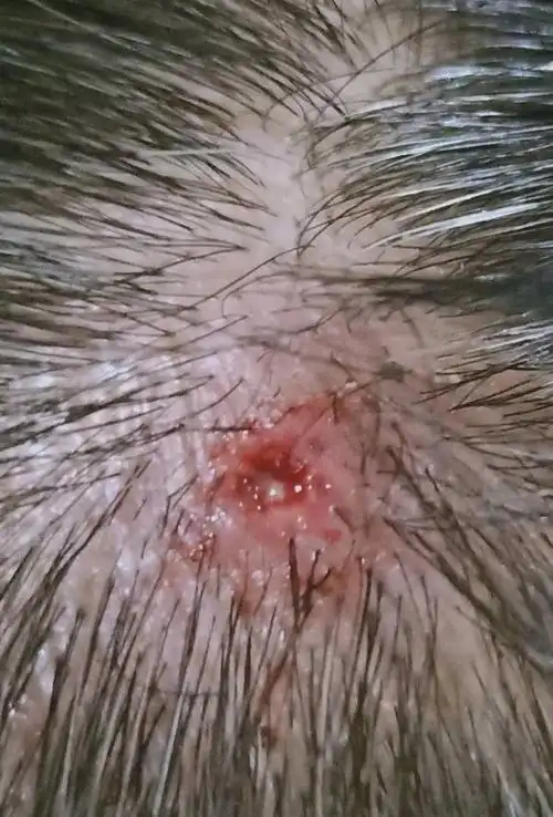 头上有个痘痘,很疼,周围红肿有化脓,怎么办?脓弄不干净