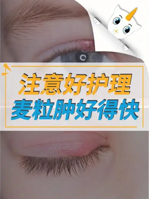 麦粒肿护理期间注意这些好得快60