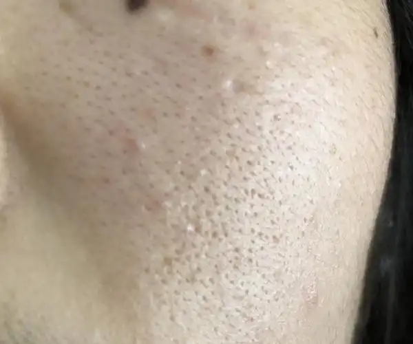 想问一下我脸上这是毛孔粗大!还是什么黑头啊?(.