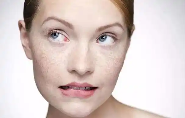 皮肤中的黑色素颗粒30%是可见的,70%是隐藏的,所以,每个人脸上或多或