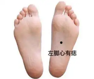左脚脚底有痣详解男女左脚脚底有痣代表什么