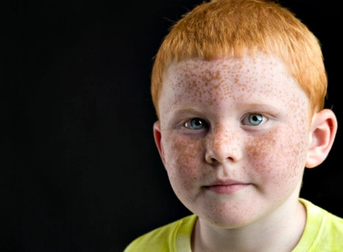 请为自己的皮肤号号脉面部色斑雀斑