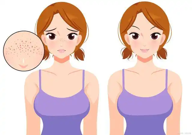女性毛孔粗大怎么办?这5种方法可缩小脸部毛孔!