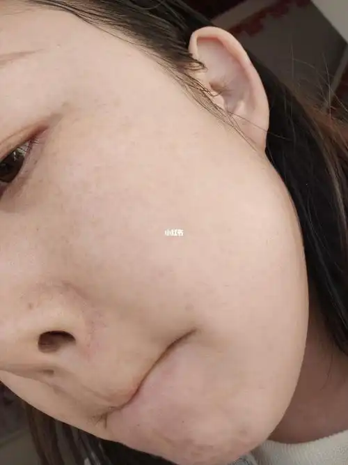 泛红敏感肌红血丝