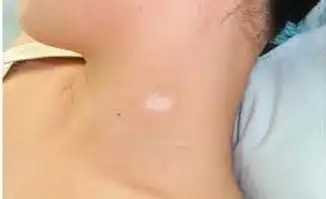 白斑病的初期表现有哪些