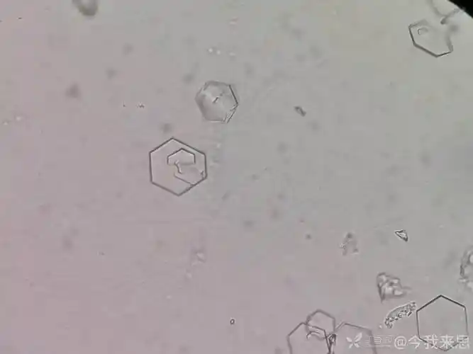 这是胱氨酸结晶吗