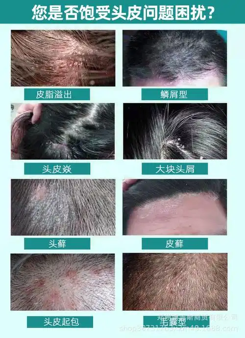 百峰草苗方屑霸祛屑头皮痒油头皮毛囊屑康王祛屑头藓霸