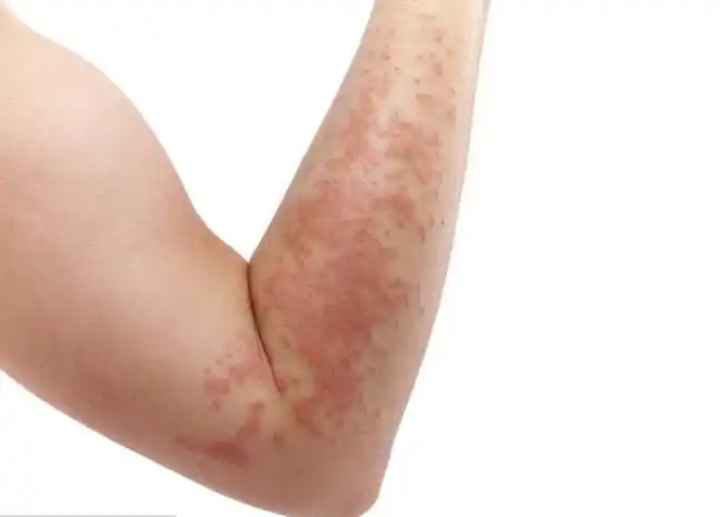 皮肤湿毒症状图片37