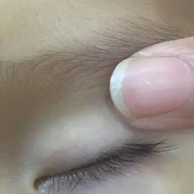 我宝宝九个月了 最近一段时间左眼下面眼角的位置长了好几个小痘痘 有