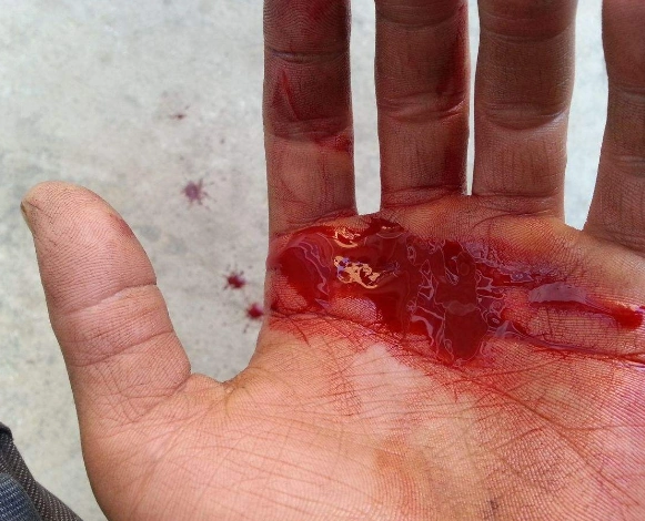 手出血的图片 (39)_有来医生