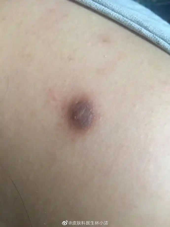 皮肤科医生林小清超话皮肤病超话这个要考虑是皮肤纤维瘤,可以不处理