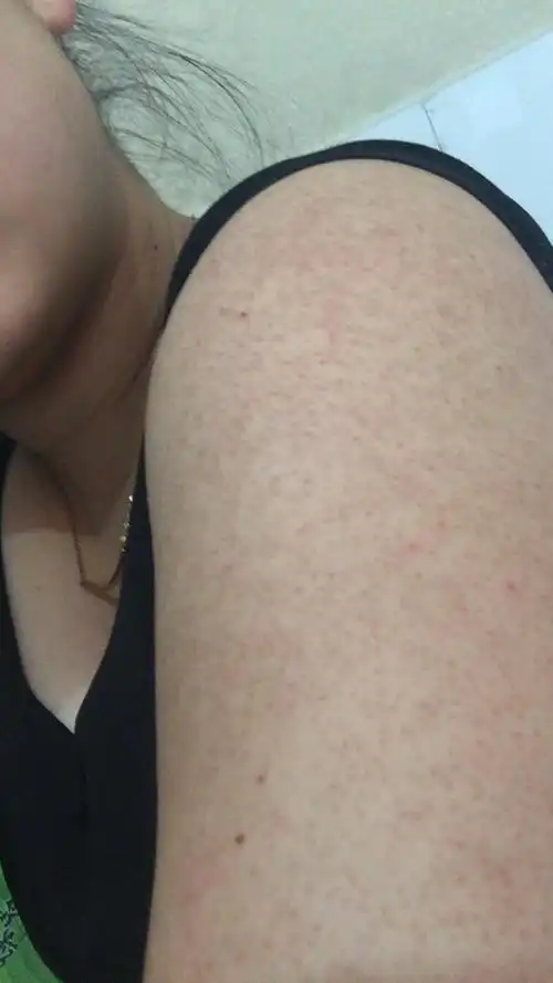 胳膊毛孔堵塞发红能挤出来白色的东西