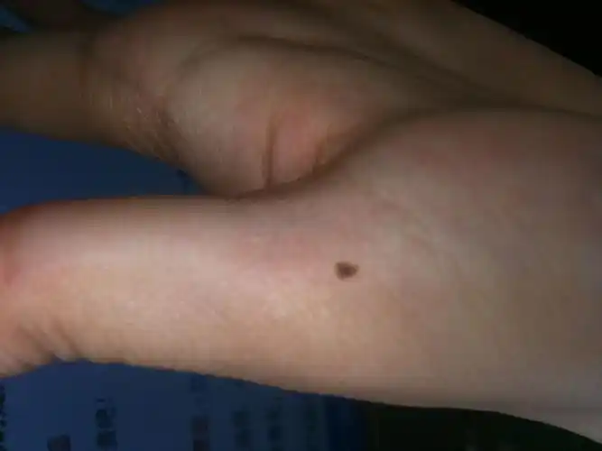 手掌黑痣 大拇指下 大鱼际上