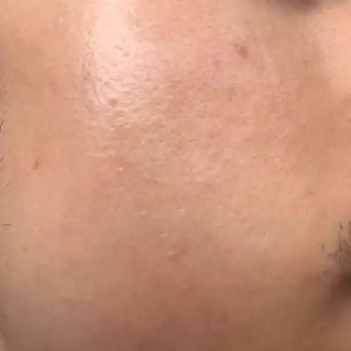 请问我脸上是皮肤角质层厚还是皮肤受损.