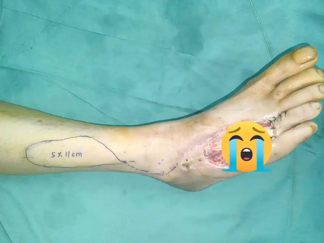 外伤后皮肤坏死,骨头外露,钢板外露,皮瓣完美覆盖修复#愿所有 - 抖音