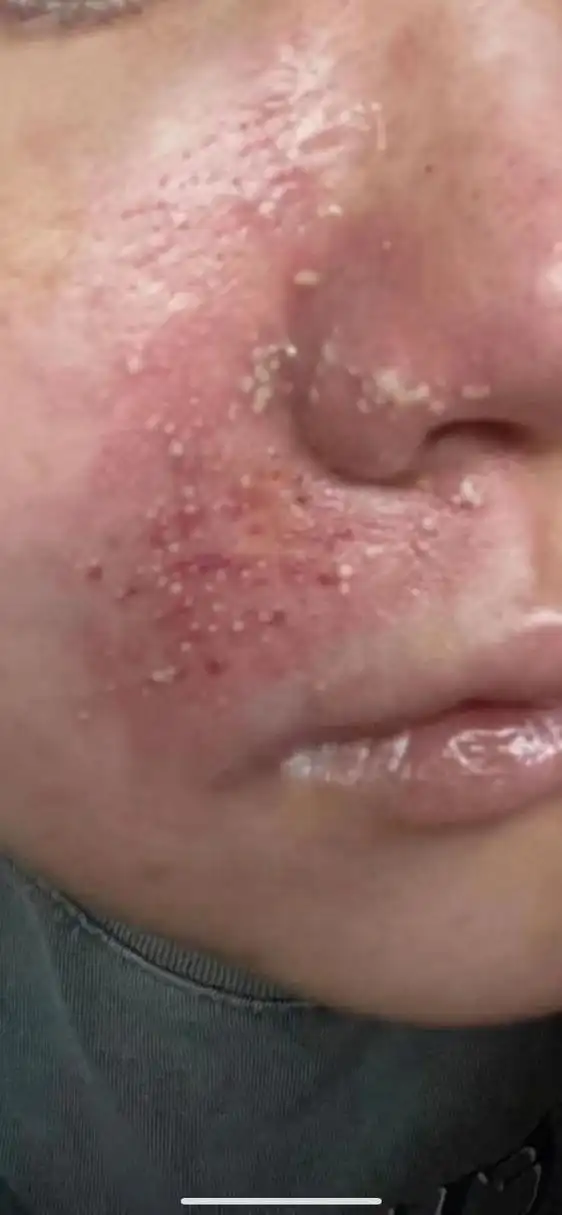 法令纹玻尿酸填充后栓塞的患者,今天是第四天,皮肤发暗,色黑,毛孔出脓