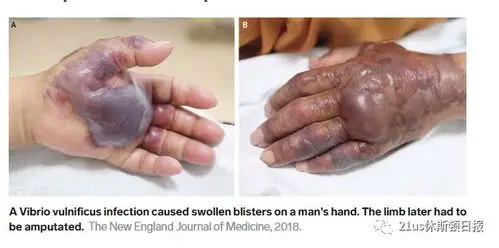 这种可怕肉食性细菌正在美国蔓延开来.