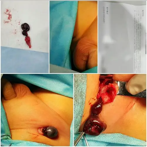 右侧阴囊空虚,腹股沟包块很硬,触痛,彩超提示睾丸血运差,手术探查发现