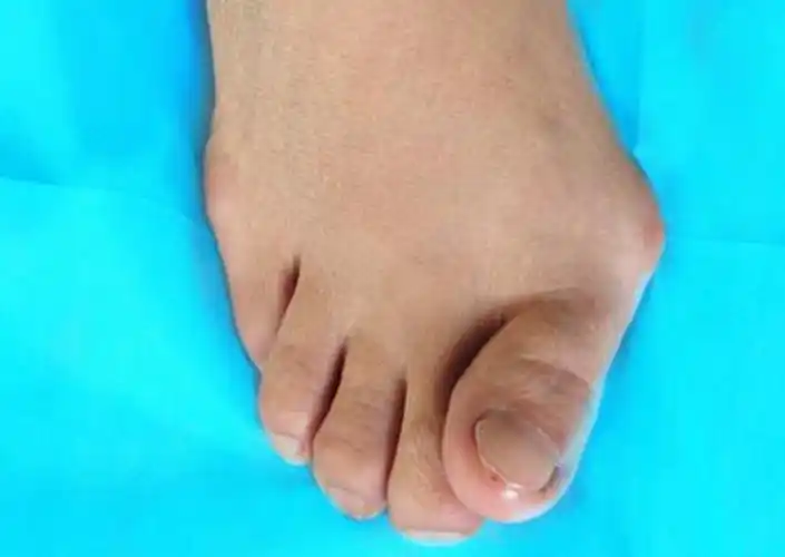 不同拇外翻手术方案疤痕图片_有来医生